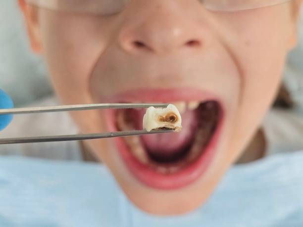 Best Emergency Dental Care for Broken or Chipped Teeth in New Albany, IN